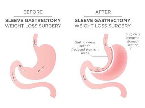 Gastric Sleeve